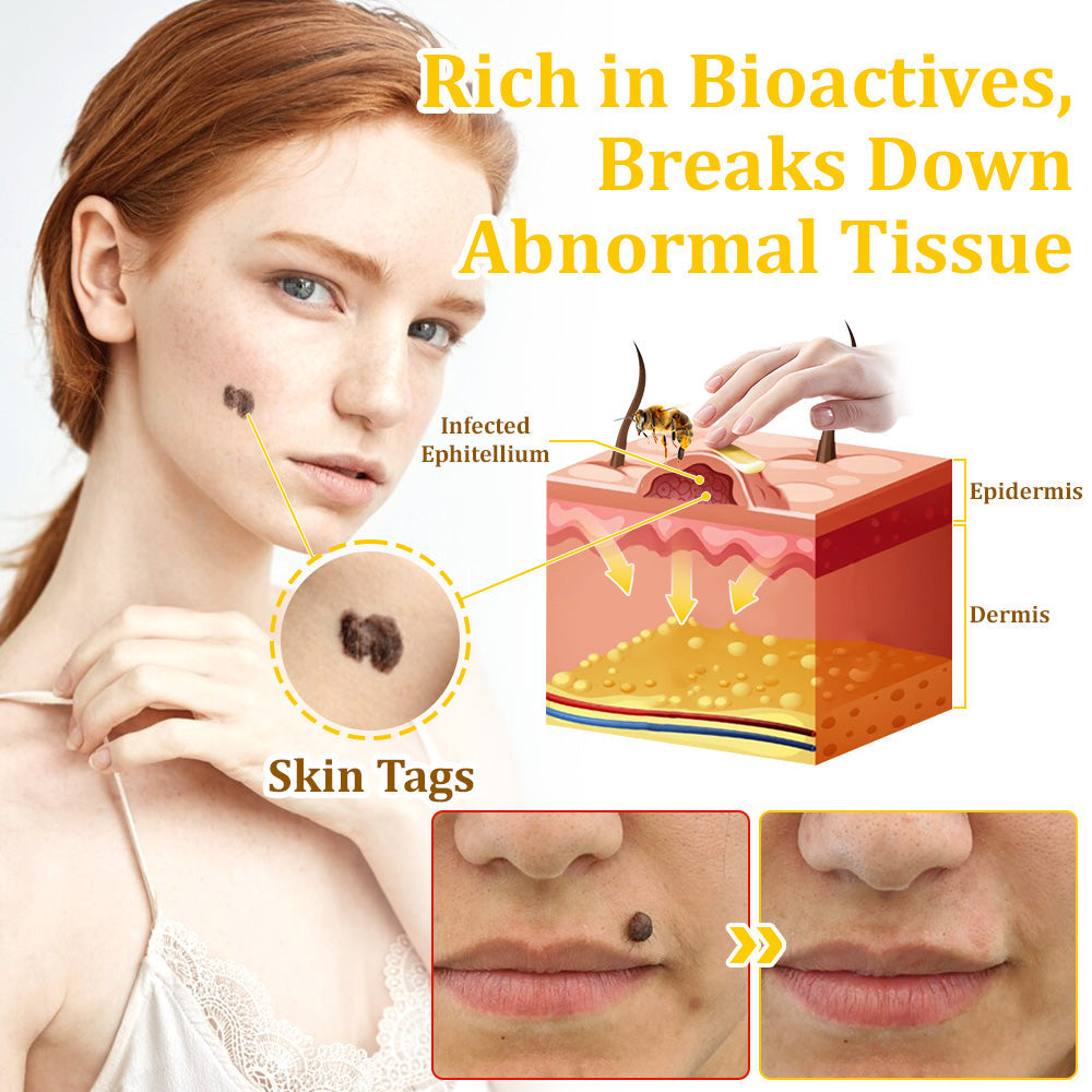 ✅flysmus™ Bee Venom Treatment Cream🌿: Relieves Eczema, Psoriasis, Acne, Rosacea, Fungal Infections (e.g., Athlete’s Foot), Warts