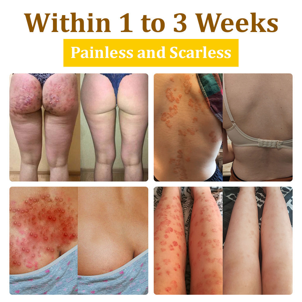 ✅flysmus™ Bee Venom Treatment Cream🌿: Relieves Eczema, Psoriasis, Acne, Rosacea, Fungal Infections (e.g., Athlete’s Foot), Warts