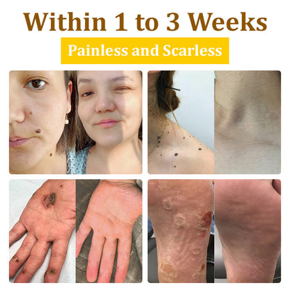 ✅flysmus™ Bee Venom Treatment Cream🌿: Relieves Eczema, Psoriasis, Acne, Rosacea, Fungal Infections (e.g., Athlete’s Foot), Warts
