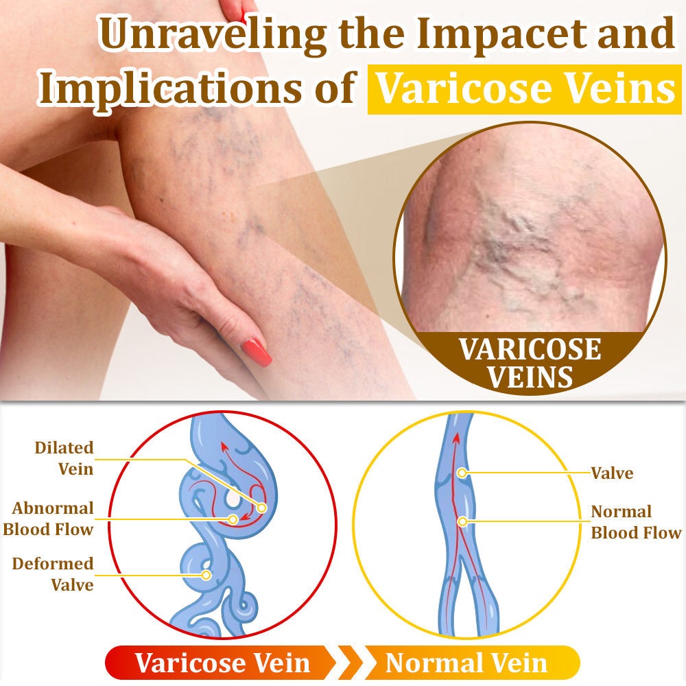 ✅flysmus™ Bee Venom Treatment Cream🌿: Relieves Eczema, Psoriasis, Acne, Rosacea, Fungal Infections (e.g., Athlete’s Foot), Warts