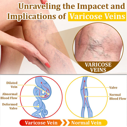 ✅flysmus™ Bee Venom Treatment Cream🌿: Relieves Eczema, Psoriasis, Acne, Rosacea, Fungal Infections (e.g., Athlete’s Foot), Warts